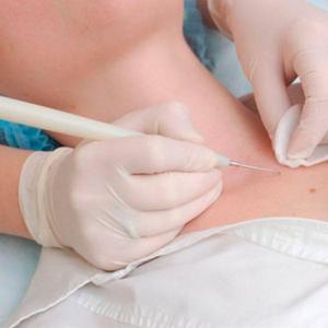 Аппарат Сургитрон - РАДИОволновое удаление папилом,родинок.