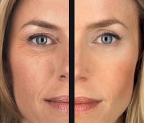 Rf- лифтинг — Мгновенное преображение кожи!