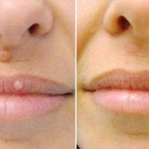 Аппарат Сургитрон - РАДИОволновое удаление папилом,родинок.